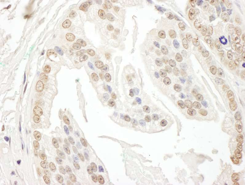 Detection of Human POLR3D by Immunohistochemistry. Sample: FFPE section of human prostate carcinoma. Antibody: Affinity purified rabbit anti-POLR3D used at a dilution of 1:1000 (0.2 ug/ml). Detection: DAB.