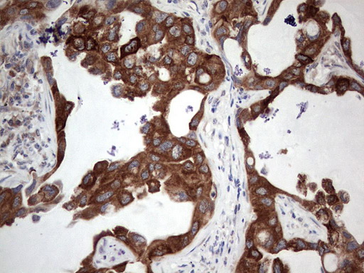 IHC of paraffin-embedded Carcinoma of Human lung tissue using anti-SGK196 Mouse monoclonal antibody. (heat-induced epitope retrieval by 1 mM EDTA in 10mM Tris, pH8.5, 120°C for 3min).