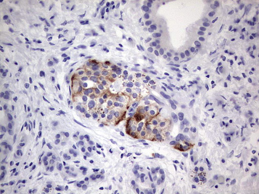 IHC of paraffin-embedded Carcinoma of Human pancreas tissue using anti-SGK196 Mouse monoclonal antibody. (heat-induced epitope retrieval by 1 mM EDTA in 10mM Tris, pH8.5, 120°C for 3min).