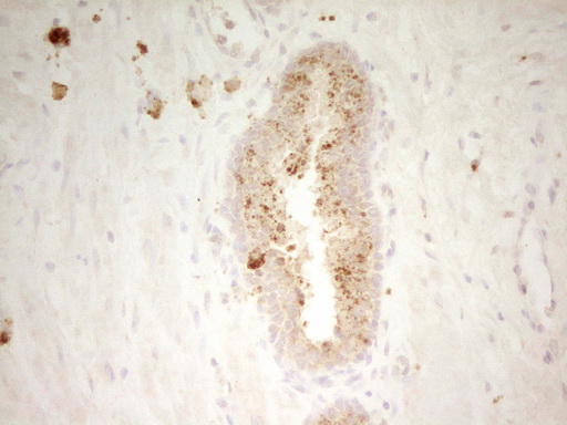 IHC of paraffin-embedded Adenocarcinoma of Human endometrium tissue using anti-PON3 mouse monoclonal antibody. (Heat-induced epitope retrieval by 1 mM EDTA in 10mM Tris, pH8.5, 120°C for 3min).