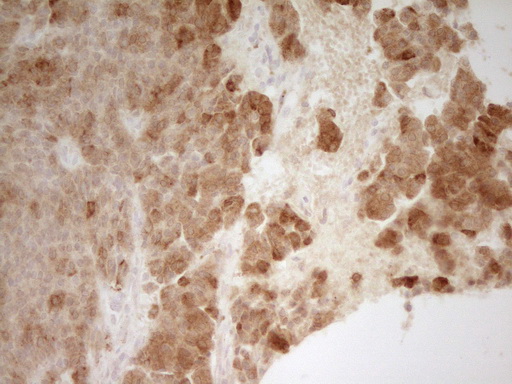 IHC of paraffin-embedded Carcinoma of Human lung tissue using anti-PON3 mouse monoclonal antibody. (Heat-induced epitope retrieval by 1 mM EDTA in 10mM Tris, pH8.5, 120°C for 3min).
