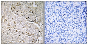 IHC of paraffin-embedded human prostate carcinoma, using POTE8 Antibody. The picture on the right is treated with the synthesized peptide.