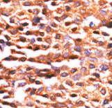 Formalin-fixed and paraffin-embedded human cancer tissue reacted with the primary antibody, which was peroxidase-conjugated to the secondary antibody, followed by DAB staining. This data demonstrates the use of this antibody for immunohistochemistry; clinical relevance has not been evaluated. BC = breast carcinoma; HC = hepatocarcinoma.