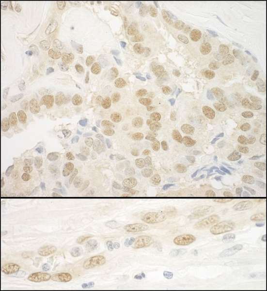 Detection of Human MKL2 by Immunohistochemistry. Sample: FFPE section of human prostate carcinoma and linitis plastica stomach cancer. Antibody: Affinity purified rabbit anti-MKL2 used at a dilution of 1:200 (1and 1:1000 (0.2 Detection: DAB.