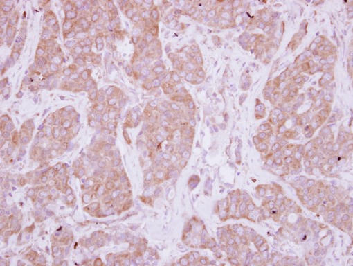 IHC of paraffin-embedded Breast ca, using PPEF1 antibody at 1:250 dilution.