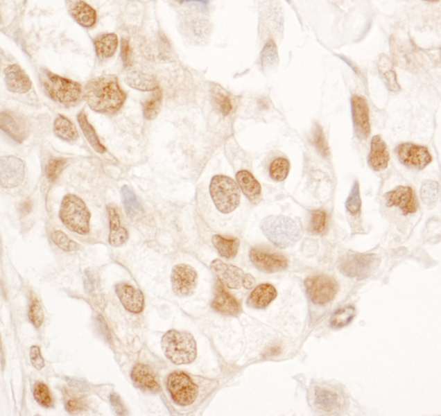 Detection of Human SRcyp by Immunohistochemistry. Sample: FFPE section of human breast carcinoma. Antibody: Affinity purified rabbit anti-SRcyp used at a dilution of 1:200 (1 ug/ml). Detection: DAB.