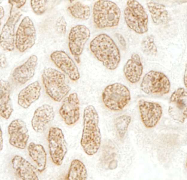 Detection of Human SRcyp by Immunohistochemistry. Sample: FFPE section of human ovarian carcinoma. Antibody: Affinity purified rabbit anti-SRcyp used at a dilution of 1:250.