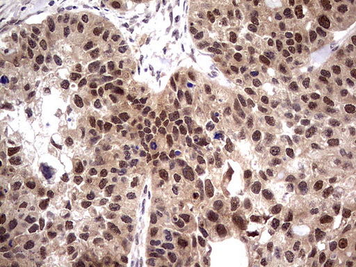 IHC of paraffin-embedded Carcinoma of Human kidney tissue using anti-PPIL1 mouse monoclonal antibody. (Heat-induced epitope retrieval by 1 mM EDTA in 10mM Tris, pH8.5, 120°C for 3min).