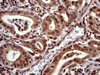 IHC of paraffin-embedded human gastric carcinoma using anti-PP2C-alpha antibody