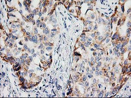 IHC of paraffin-embedded Carcinoma of Human lung tissue using anti-PPM1B mouse monoclonal antibody.