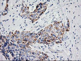 IHC of paraffin-embedded Adenocarcinoma of Human breast tissue using anti-PPM1B mouse monoclonal antibody.
