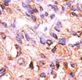 Formalin-fixed and paraffin-embedded human cancer tissue reacted with the primary antibody, which was peroxidase-conjugated to the secondary antibody, followed by AEC staining. This data demonstrates the use of this antibody for immunohistochemistry; clinical relevance has not been evaluated. BC = breast carcinoma; HC = hepatocarcinoma.
