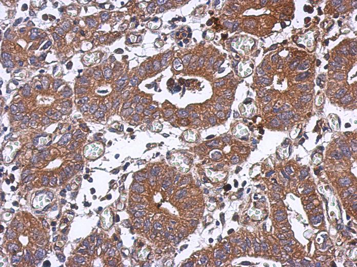 IHC of paraffin-embedded Colon ca, using PPM1J antibody at 1:500 dilution.
