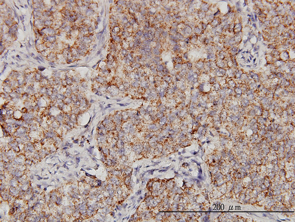 Immunoperoxidase of monoclonal antibody to PPOX on formalin-fixed paraffin-embedded human lung, adenosquamous cell carcinoma. [antibody concentration 3 ug/ml].