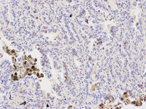Immunohistochemistry of paraffin-embedded human lung cancer using PPP1CB antibody at dilution of 1:200 (200x lens).