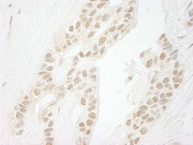 Detection of Human PPP1CC by Immunohistochemistry. Sample: FFPE section of human breast carcinoma. Antibody: Affinity purified rabbit anti-PPP1CC used at a dilution of 1:250. Epitope Retrieval Buffer-High pH (IHC-101J) was substituted for Epitope Retrieval Buffer-Reduced pH.
