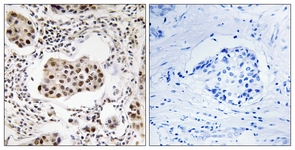 IHC of paraffin-embedded human breast carcinoma tissue, using PPP1R11 Antibody. The sample on the right was incubated with synthetic peptide.