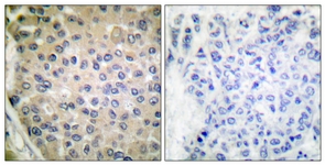 IHC of paraffin-embedded human breast carcinoma, using CPI17 alpha (Phospho-Thr38) Antibody. The picture on the right is treated with the synthesized peptide.