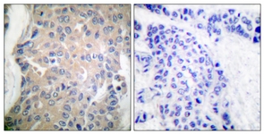IHC of paraffin-embedded human breast carcinoma tissue, using CPI17 alpha (Ab-38) Antibody. The picture on the right is treated with the synthesized peptide.