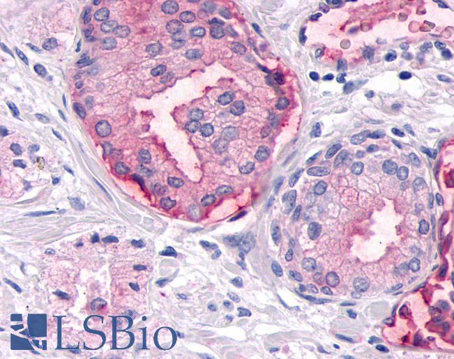 Anti-MKP-8 / DUSP26 antibody IHC of human Prostate, Carcinoma. Immunohistochemistry of formalin-fixed, paraffin-embedded tissue after heat-induced antigen retrieval.