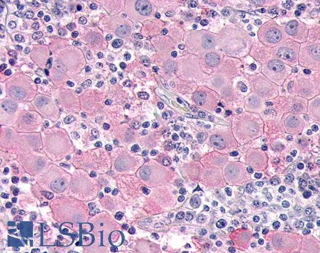 Anti-MKP-8 / DUSP26 antibody IHC of human Skin, Melanoma. Immunohistochemistry of formalin-fixed, paraffin-embedded tissue after heat-induced antigen retrieval.