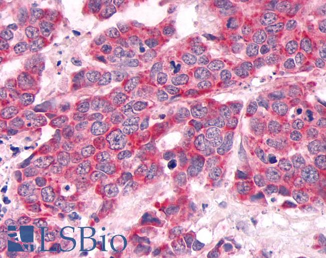 Anti-MKP-8 / DUSP26 antibody IHC of human Lung, Small Cell Carcinoma. Immunohistochemistry of formalin-fixed, paraffin-embedded tissue after heat-induced antigen retrieval.