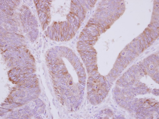 IHC of paraffin-embedded Colon ca, using PPP2R3A antibody at 1:250 dilution.
