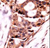 Formalin-fixed and paraffin-embedded human cancer tissue reacted with the primary antibody, which was peroxidase-conjugated to the secondary antibody, followed by AEC staining. This data demonstrates the use of this antibody for immunohistochemistry; clinical relevance has not been evaluated. BC = breast carcinoma; HC = hepatocarcinoma.