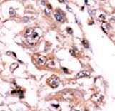 Formalin-fixed and paraffin-embedded human cancer tissue reacted with the primary antibody, which was peroxidase-conjugated to the secondary antibody, followed by AEC staining. This data demonstrates the use of this antibody for immunohistochemistry; clinical relevance has not been evaluated. BC = breast carcinoma; HC = hepatocarcinoma.