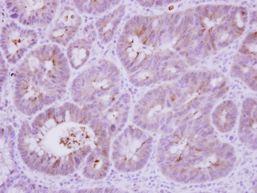 IHC of paraffin-embedded Colon ca, using Calcineurin B antibody at 1:250 dilution.