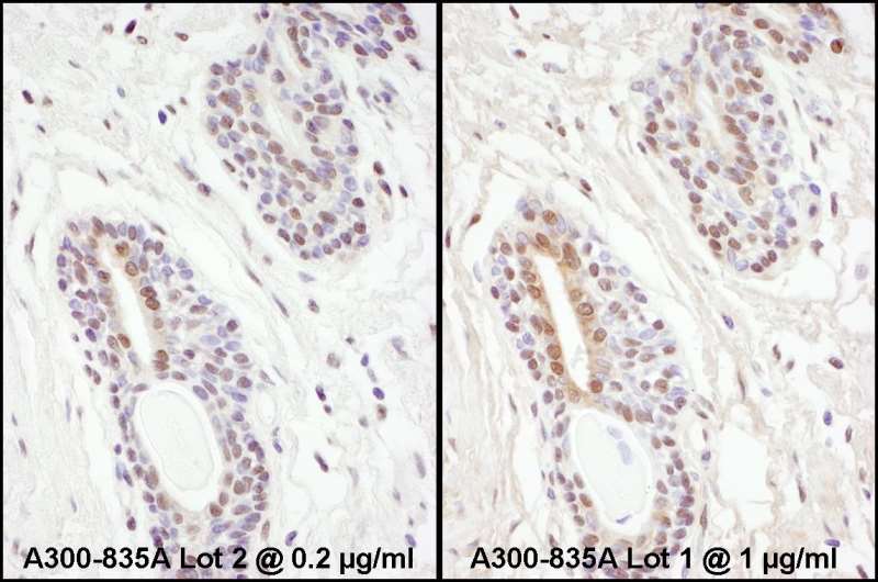 Detection of Human PPP4C by Immunohistochemistry. Samples: FFPE serial sections of human prostate carcinoma. Antibody: Affinity purified rabbit anti-PPP4C used at a dilution of 1:1000 (0.2 ug/ml). Detection: DAB.