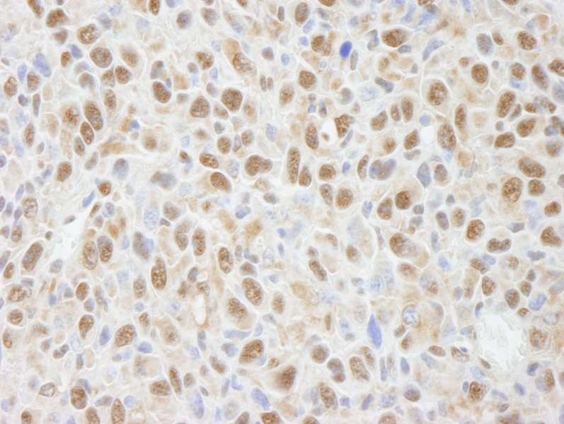Detection of Mouse PPP4C by Immunohistochemistry. Sample: FFPE section of mouse squamous cell carcinoma. Antibody: Affinity purified rabbit anti-PPP4C used at a dilution of 1:100.