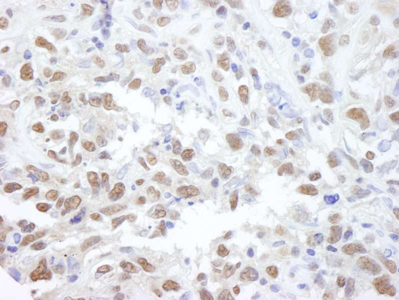 Detection of Human PPP4C by Immunohistochemistry. Sample: FFPE section of human metastatic lymph node. Antibody: Affinity purified rabbit anti-PPP4C used at a dilution of 1:500.