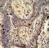 PPRC1 antibody immunohistochemistry of formalin-fixed and paraffin-embedded human lung carcinoma followed by peroxidase-conjugated secondary antibody and DAB staining.