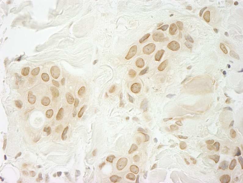 Detection of Human MKRN1 by Immunohistochemistry. Sample: FFPE section of human breast carcinoma. Antibody: Affinity purified rabbit anti-MKRN1 used at a dilution of 1:100. Epitope Retrieval Buffer-High pH (IHC-101J) was substituted for Epitope Retrieval Buffer-Reduced pH.