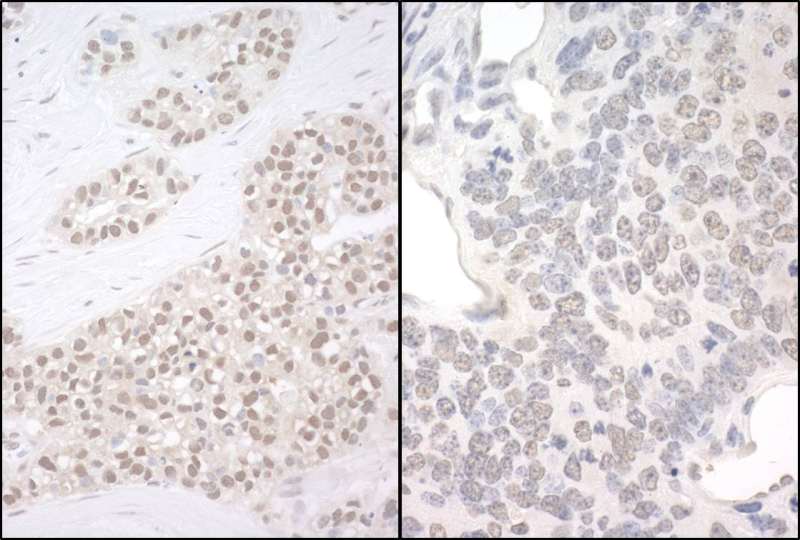 Detection of Human and Mouse PQBP1 by Immunohistochemistry. Sample: FFPE section of human breast carcinoma (left) and mouse teratoma (right). Antibody: Affinity purified rabbit anti-PQBP1 used at a dilution of 1:200 (1 ug/mg).
