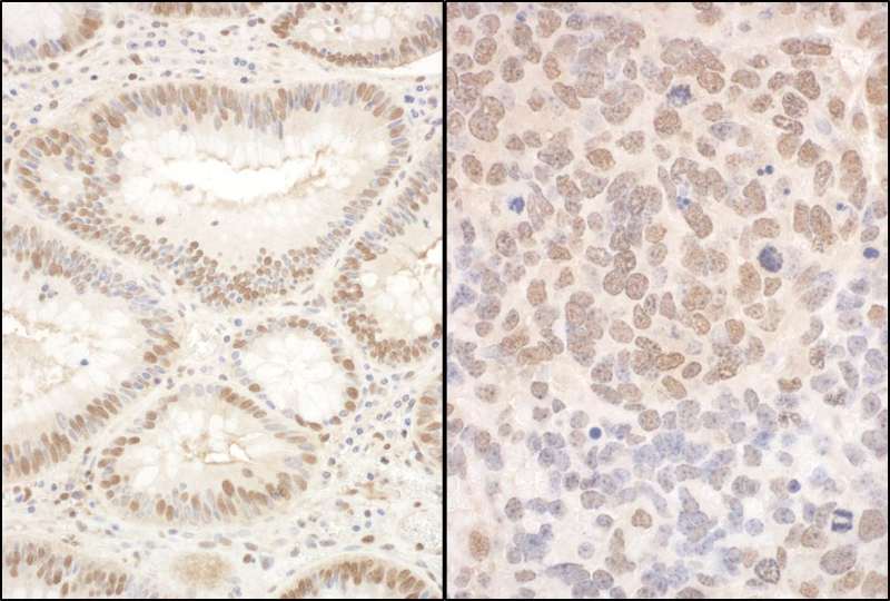 Detection of Human and Mouse PQBP1 by Immunohistochemistry. Sample: FFPE section of human breast carcinoma (left) and mouse teratoma (right). Antibody: Affinity purified rabbit anti-PQBP1 used at a dilution of 1:1000 (1 ug/mg).
