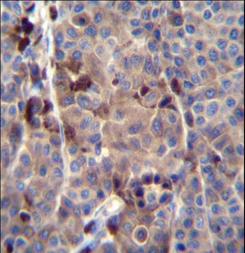 PRAMEF8 Antibody immunohistochemistry of formalin-fixed and paraffin-embedded human melanoma tissue followed by peroxidase-conjugated secondary antibody and DAB staining.