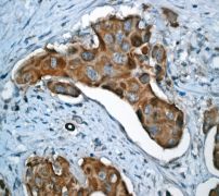 IHC of paraffin-embedded human cervical carcinoma using anti-PRC1 antibody.