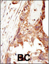 Formalin-fixed and paraffin-embedded human cancer tissue reacted with the primary antibody, which was peroxidase-conjugated to the secondary antibody, followed by DAB staining. This data demonstrates the use of this antibody for immunohistochemistry; clinical relevance has not been evaluated. BC = breast carcinoma; HC = hepatocarcinoma.