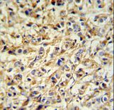 PRELP Antibody IHC of formalin-fixed and paraffin-embedded breast carcinoma followed by peroxidase-conjugated secondary antibody and DAB staining.