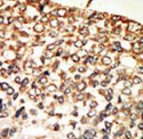 Formalin-fixed and paraffin-embedded human cancer tissue reacted with the primary antibody, which was peroxidase-conjugated to the secondary antibody, followed by AEC staining. This data demonstrates the use of this antibody for immunohistochemistry; clinical relevance has not been evaluated. BC = breast carcinoma; HC = hepatocarcinoma.