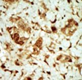 Formalin-fixed and paraffin-embedded human cancer tissue reacted with the primary antibody, which was peroxidase-conjugated to the secondary antibody, followed by DAB staining. This data demonstrates the use of this antibody for immunohistochemistry; clinical relevance has not been evaluated. BC = breast carcinoma; HC = hepatocarcinoma.
