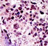 Formalin-fixed and paraffin-embedded human cancer tissue reacted with the primary antibody, which was peroxidase-conjugated to the secondary antibody, followed by AEC staining. This data demonstrates the use of this antibody for immunohistochemistry; clinical relevance has not been evaluated. BC = breast carcinoma; HC = hepatocarcinoma.