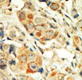 Formalin-fixed and paraffin-embedded human cancer tissue reacted with the primary antibody, which was peroxidase-conjugated to the secondary antibody, followed by DAB staining. This data demonstrates the use of this antibody for immunohistochemistry; clinical relevance has not been evaluated. BC = breast carcinoma; HC = hepatocarcinoma.