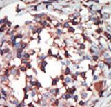 Formalin-fixed and paraffin-embedded human cancer tissue reacted with the primary antibody, which was peroxidase-conjugated to the secondary antibody, followed by AEC staining. This data demonstrates the use of this antibody for immunohistochemistry; clinical relevance has not been evaluated. BC = breast carcinoma; HC = hepatocarcinoma.