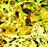 Formalin-fixed and paraffin-embedded human cancer tissue reacted with the primary antibody, which was peroxidase-conjugated to the secondary antibody, followed by AEC staining. This data demonstrates the use of this antibody for immunohistochemistry; clinical relevance has not been evaluated. BC = breast carcinoma; HC = hepatocarcinoma.