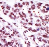 Formalin-fixed and paraffin-embedded human cancer tissue reacted with the primary antibody, which was peroxidase-conjugated to the secondary antibody, followed by AEC staining. This data demonstrates the use of this antibody for immunohistochemistry; clinical relevance has not been evaluated. BC = breast carcinoma; HC = hepatocarcinoma.