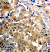 Immunohistochemical analysis of paraffin-embedded human lung carcinoma tissue, using Phospho-PRKCZ-T410 antibody.