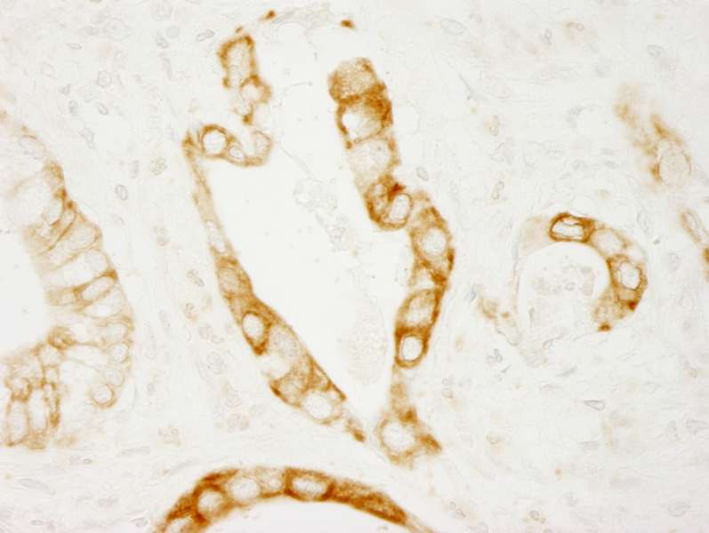 Detection of Human PKD2 by Immunohistochemistry. Sample: FFPE section of human stomach adenocarcinoma. Antibody: Affinity purified rabbit anti-PKD2 used at a dilution of 1:250. Epitope Retrieval Buffer-High pH (IHC-101J) was substituted for Epitope Retrieval Buffer-Reduced pH.